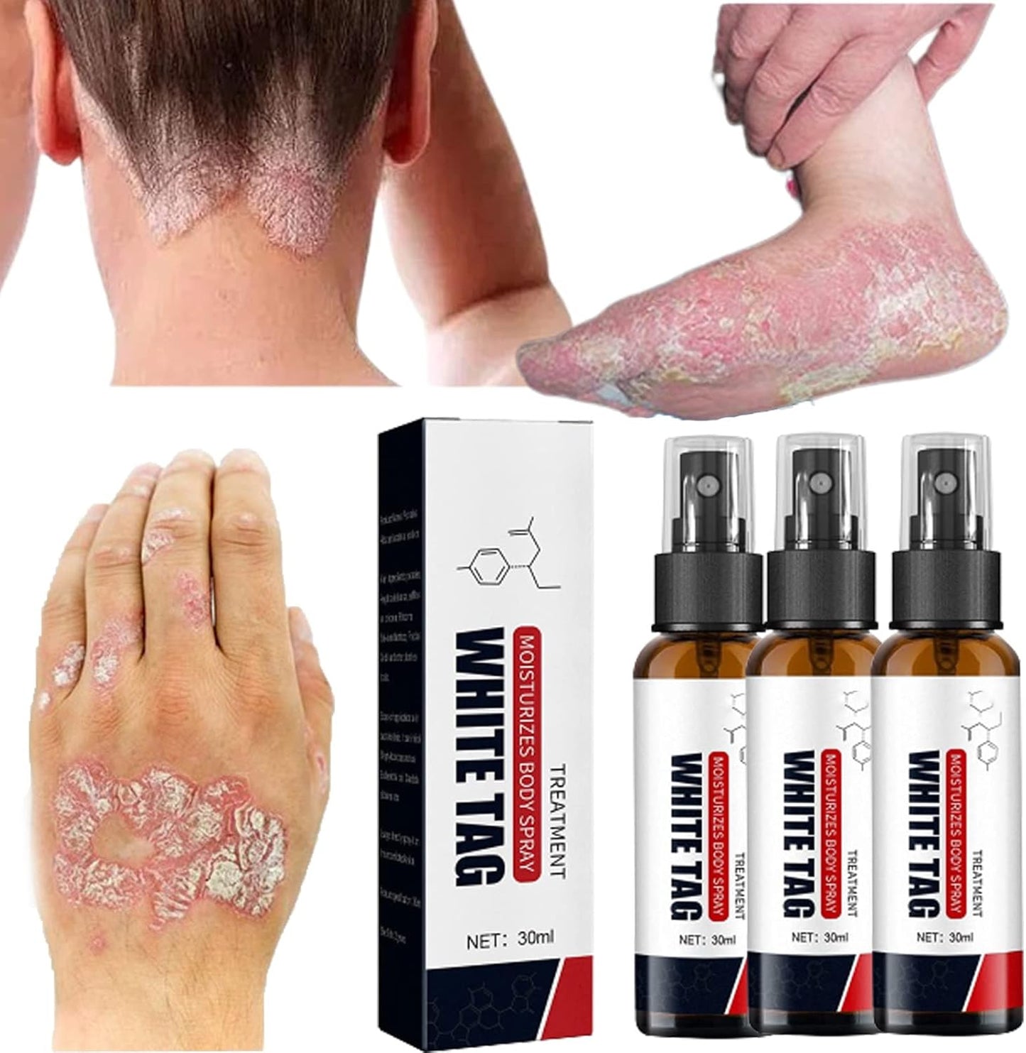 KOLMAX - SPRAY PSORIASIS: Alivio Rápido y Eficaz para tu Piel